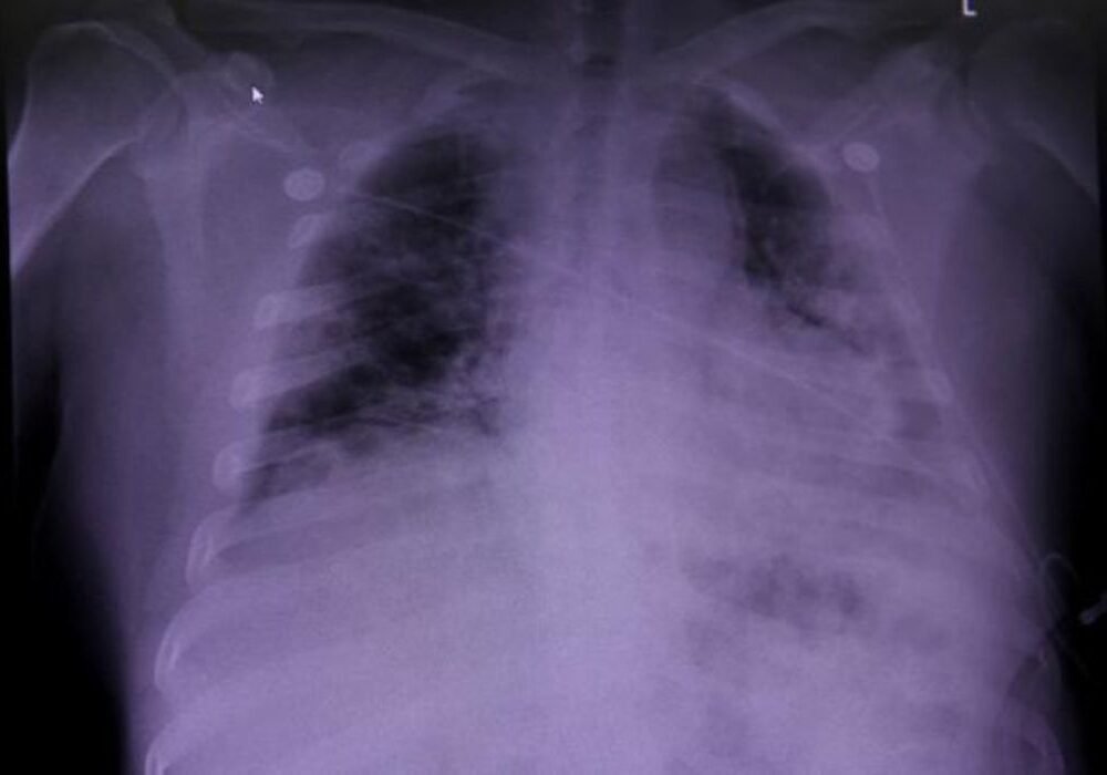 Race-neutral Lung Assessments