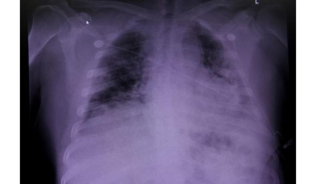 Race-neutral Lung Assessments