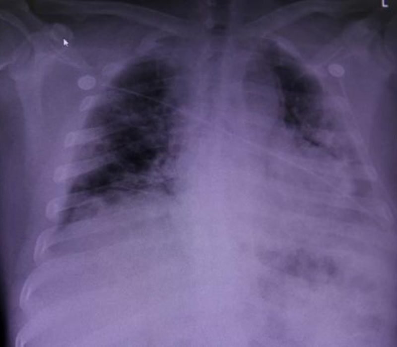 Race-neutral Lung Assessments